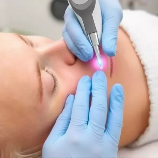 ProCell Microchanneling Services Toledo,Benefits of ProCell microchanneling,Collagen induction therapy