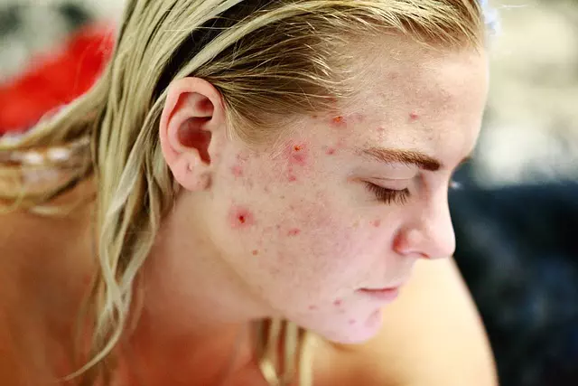 advanced-acne-scar-treatment-toledolaser-640x480-68598140.jpeg